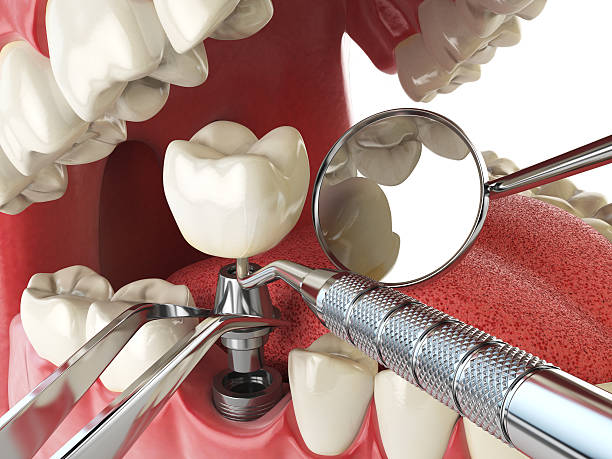 Best Emergency Root Canal Treatment in Allegan, MI